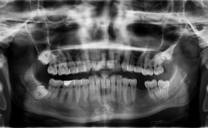 Zła droga odżywiania się to większe deficyty w jamie ustnej a także ich utratę